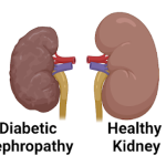 Diabetes Kidney Disease: What Is Diabetic Nephropathy?
