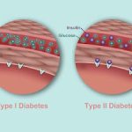 Can Type 2 Diabetes Turn Into Type 1?