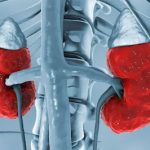 Azotemia Chronic Kidney Disease: Causes, Signs And Treatment