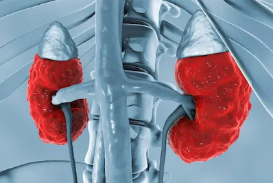 Azotemia Chronic Kidney Disease: Causes, Signs And Treatment