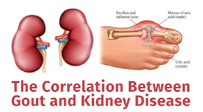 Can Gout Cause Kidney Disease?