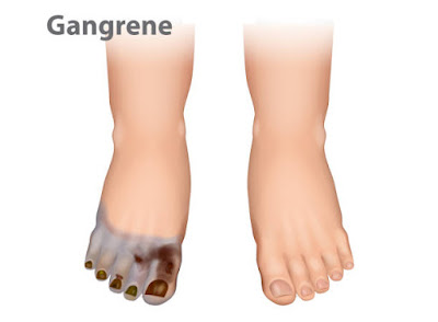 Diabetic Neuropathy: 7 Ways Protect Your Feet As A Diabetic