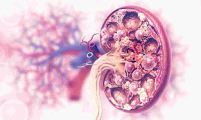 Lupus: Types, Symptoms And Lupus Nephritis Progression Causes of kidney disease