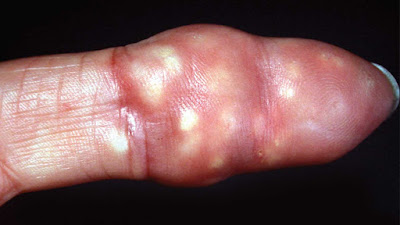 Calcinosis cutis