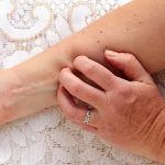 Kidney Disease Effects On Skin And How To Prevent Skin Problems