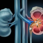 10 Basic Facts To Know About Chronic Kidney Disease