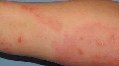 Itchy skin