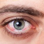 Dry Eye: Causes And Treatment