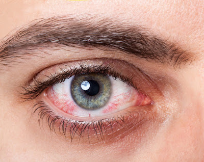 Dry Eye: Causes And Treatment