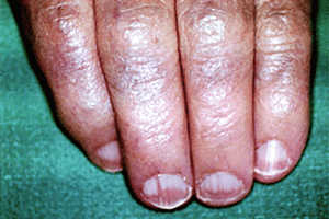 nail discoloration