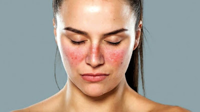 Lupus: Types, Symptoms And Lupus Nephritis Progression