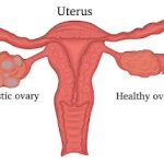 How Polycystic Ovarian Syndrome (PCOS) Might Cause Diabetes: