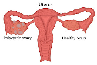 How Polycystic Ovarian Syndrome (PCOS) Might Cause Diabetes: