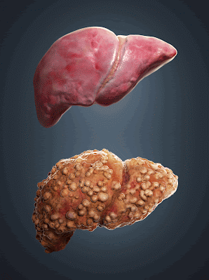 Liver Damage
