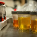 What Color Is The Urine During Kidney Failure?