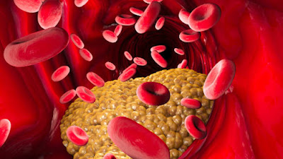 High Cholesterol Diet Is Linked With A Risk Of Type 2 Diabetes