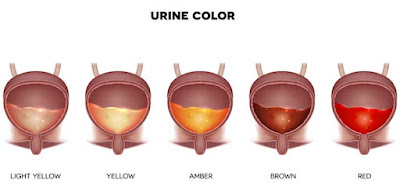 What Color Is The Urine During Kidney Failure?