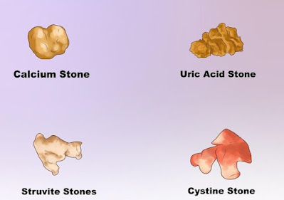 Different types of Kidney stones kidney stones