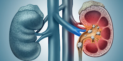 Different Types Of Kidney Stones: Causes and Treatments