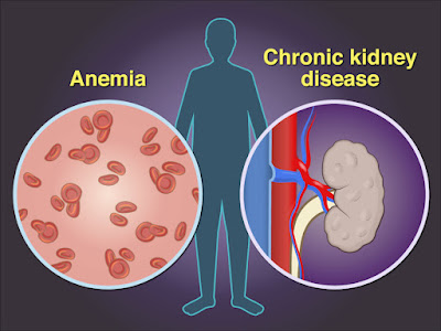 A Guide to Managing Chronic Kidney Disease-related Anemia
