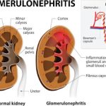 Glomerulonephritis: Causes, Symptoms, Diagnosis & Treatment