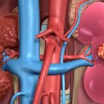 Common Causes of Kidney Disease