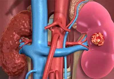 Common Causes of Kidney Disease