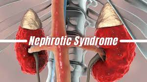 Nephrotic Syndrome:Causes, Symptoms, and Management