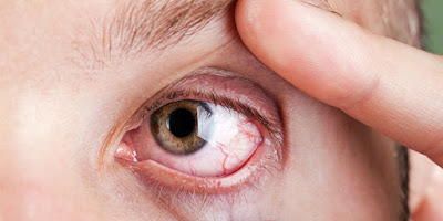 Diabetic Retinopathy: Causes, Progression, and Treatment Options