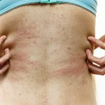 How To Manage Itching (Pruritus) in Chronic Kidney Disease (CKD)