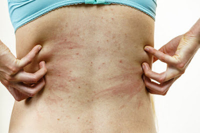 How To Manage Itching (Pruritus) in Chronic Kidney Disease (CKD)