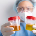 How to Reduce Proteinuria in Chronic Kidney Disease: Practical Tips and Strategies