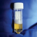 Understanding Proteinuria: A Key Marker in Chronic Kidney Disease