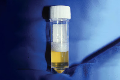 Understanding Proteinuria: A Key Marker in Chronic Kidney Disease