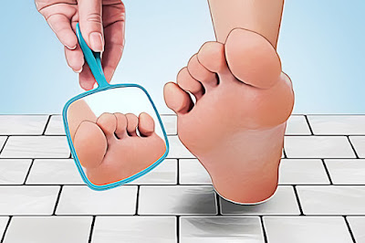 How to Recognize and Treat Diabetes-Related Foot Problems