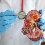 The Latest Breakthroughs in Kidney Cancer Research and Treatment