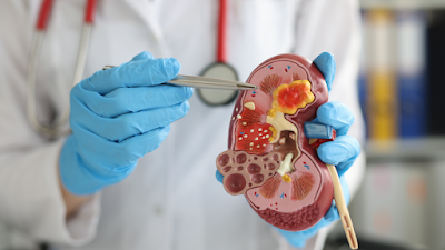 The Latest Breakthroughs in Kidney Cancer Research and Treatment