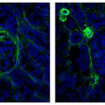 Unraveling Lupus Nephritis: The Surprising Role of Innate Lymphoid Cells