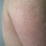 Preventing and Treating Keratosis Pilaris with Effective Strategies and Product Recommendations