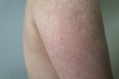 Preventing and Treating Keratosis Pilaris with Effective Strategies and Product Recommendations