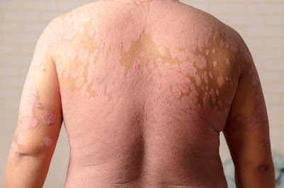 Skin Conditions Recommended Treatments