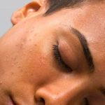 How to Manage Facial Excess Sebum Production: Oily Skincare Tips