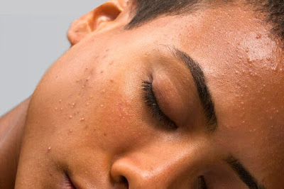 How to Manage Facial Excess Sebum Production: Oily Skincare Tips
