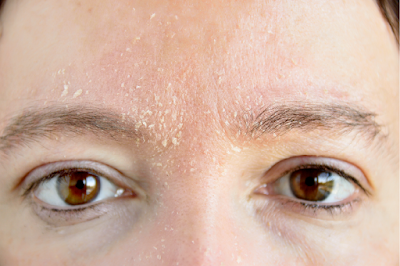 Flakiness and Rough Texture Identify & Address Signs of Skin Dehydration