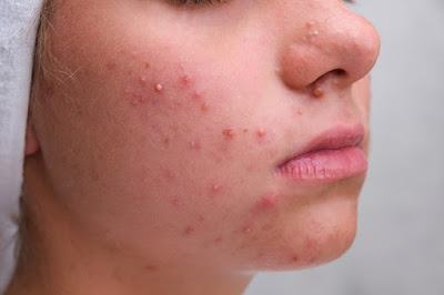 Acne: Causes, Treatment Options, and Preventive Measures