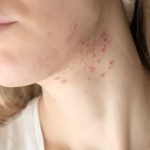 How to Treat Acne-Prone Skin