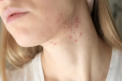 How to Treat Acne-Prone Skin