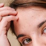 Embracing Confidence: Skincare Journey with Oily and Acne-Prone Scalp