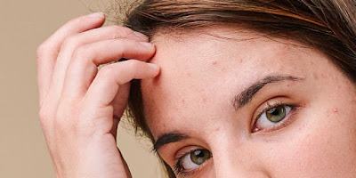 Embracing Confidence: Skincare Journey with Oily and Acne-Prone Scalp