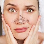 Strategies for Preventing & Treating Blackheads